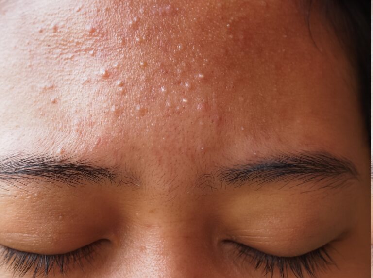 Acne Scar Treatment