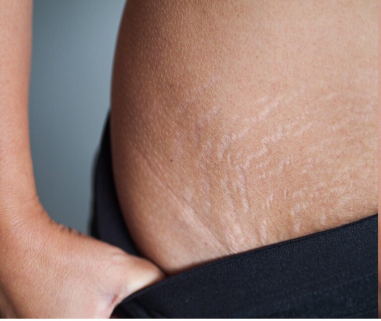 Stretch Marks Treatment